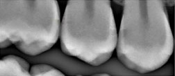 Caries Have Nowhere to Hide with RVG and LOGICON